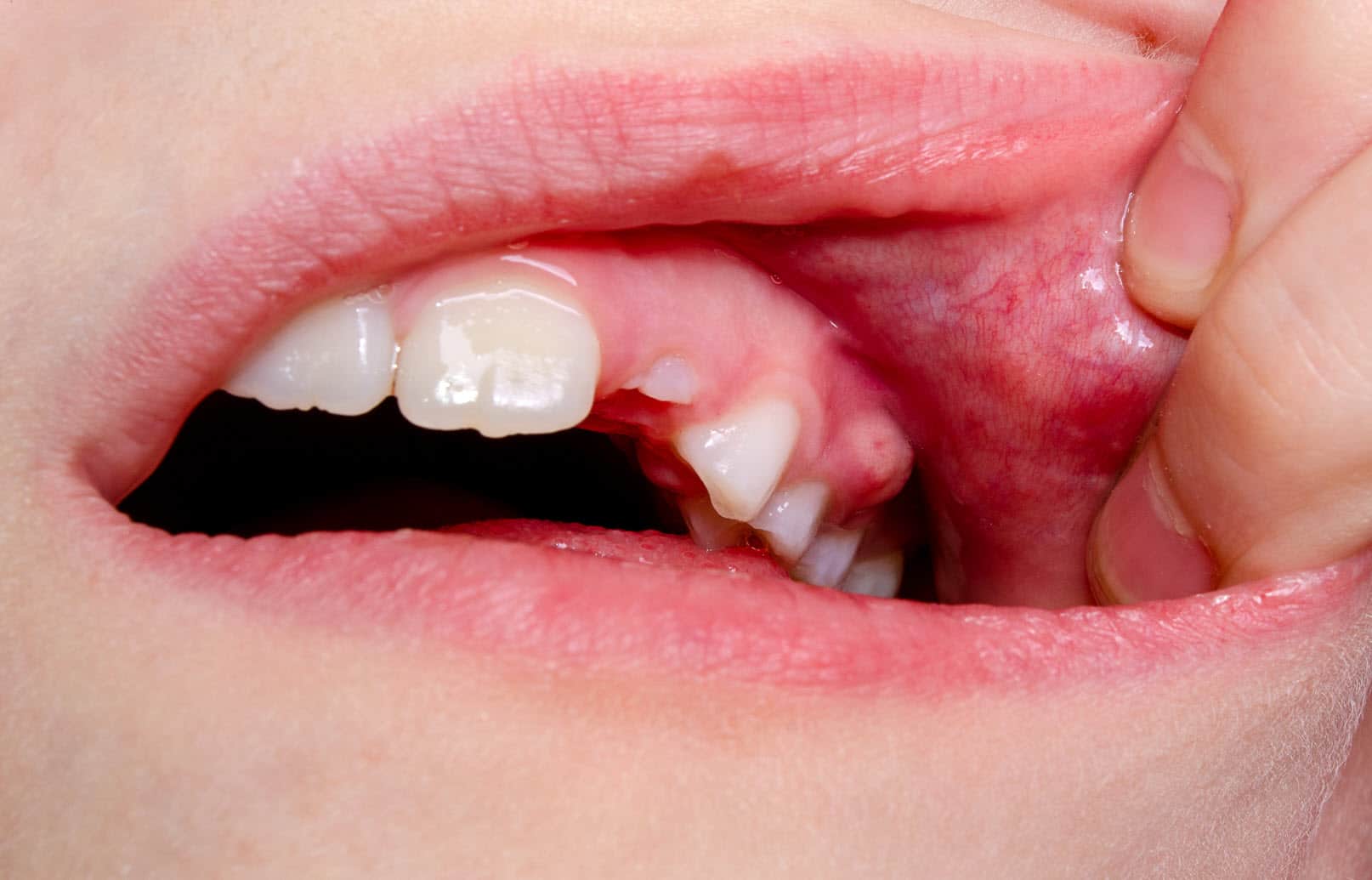 Reasons Your Tooth Abscess Is Still Swollen